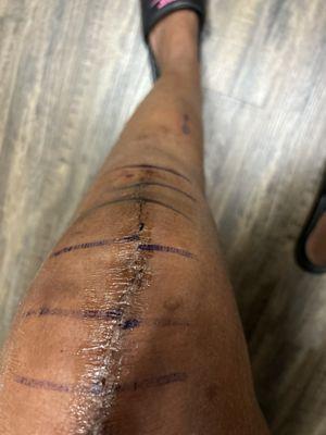 Left knee replacement from November 2023