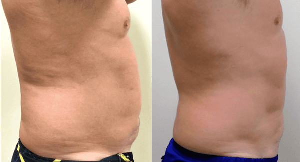 Before and after real results from using a series of UltraSlim technology for fat loss and skin tightening