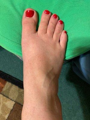 Gel Pedicure, 1 week after