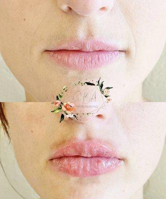 Needleless Lip Enhancement (Hya Pen)