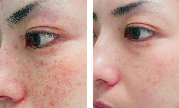 Treating age spots, freckles and sun spots
Pigmented lesions can be present at birth, or develop with age and sun exposure.