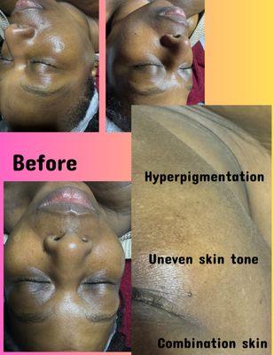 Dermaplane Facial