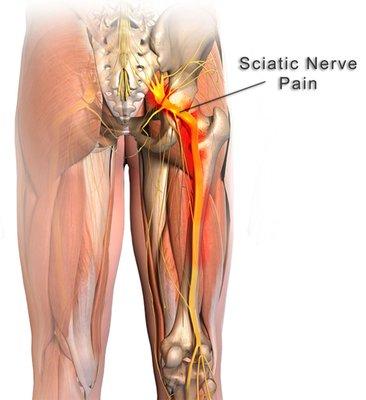 Living with sciatic pain may not be necessary.