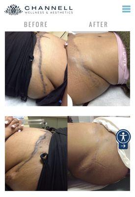 Laser scar removal