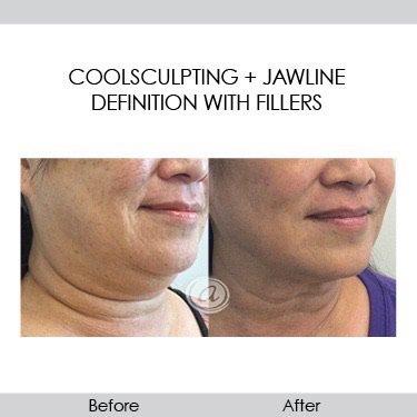 Coolsculpting + jawline definition with fillers