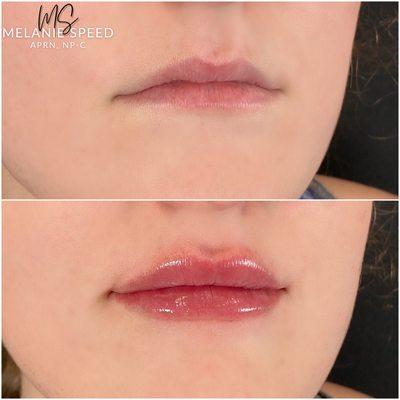 Before and after lip augmentation by Melanie Speed, APRN, NP-C