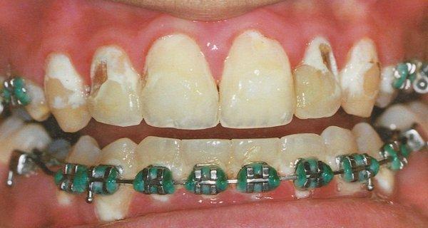 THE IMPORTANCE OF BRUSHING WELL WITH BRACES This 13 year old girl developed extensive decay on her teeth due to her very poor oral hygiene.