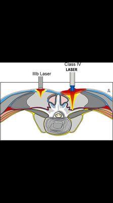 Deep Tissue Class IV Laser