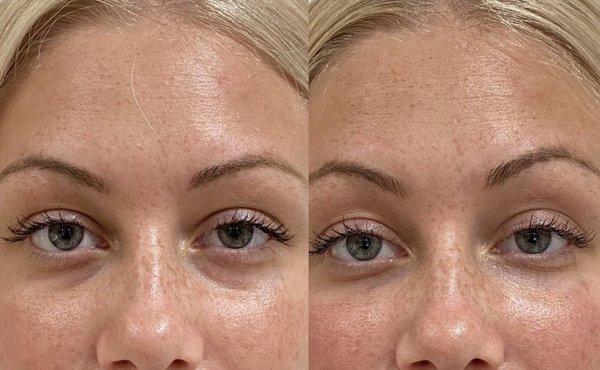 Undereye Filler