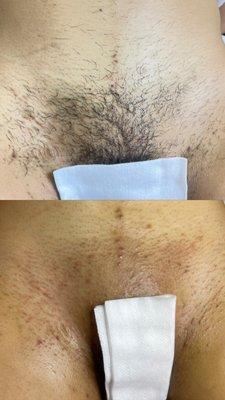 Before & After Brazilian wax