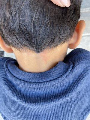 Burns hair stylist caused on my sons neck.