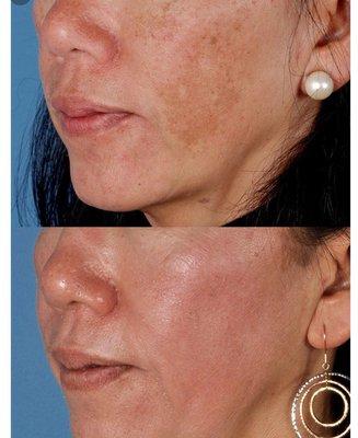 Pigmentation treatment