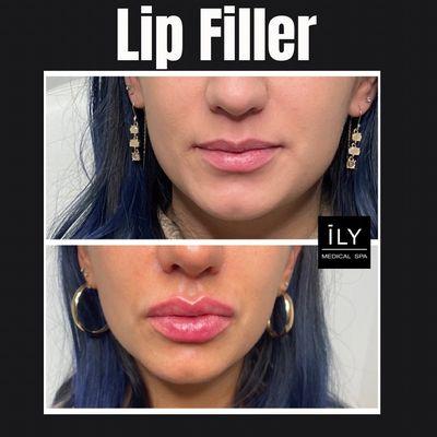 Lip Filler. Juvederm