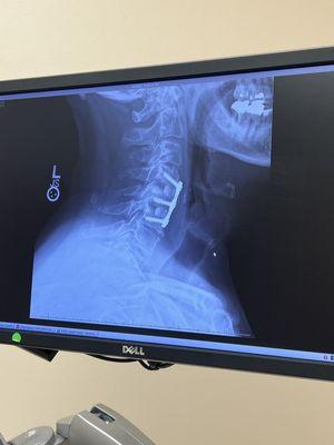 There's the six screws hubby's got in his neck now permanently