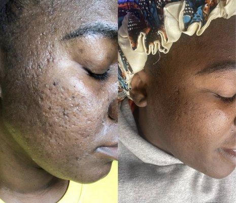 Before and after a customized treatment plan and home care regimen.