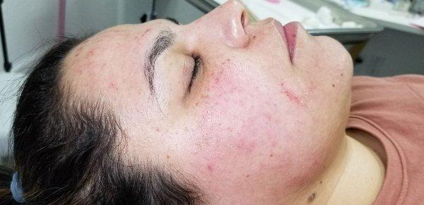 Microneedling with HA serum