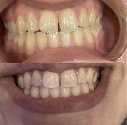 TEETH WHITENING (1 HOUR)