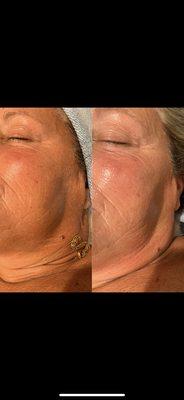 Dermaplane facial