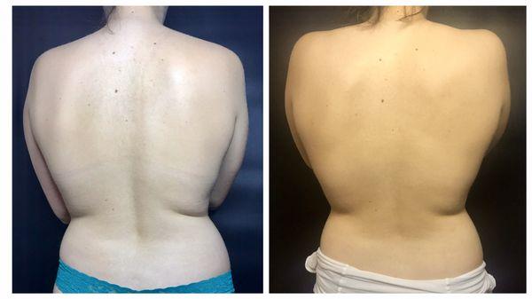 Before & After Caviation and Endermologie treatments