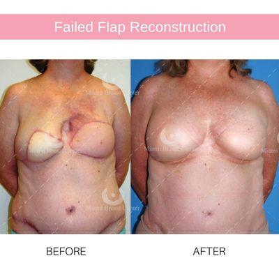 50 year old patient who had a bilateral mastectomy with reconstruction using DIEP flaps before and after her failed flap reconstruction.