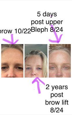 Brow 10/22 prior to septo-rhinoplasty and brow lift. Second photo 2 years post. 3rd photo 5 days post upper bleph.