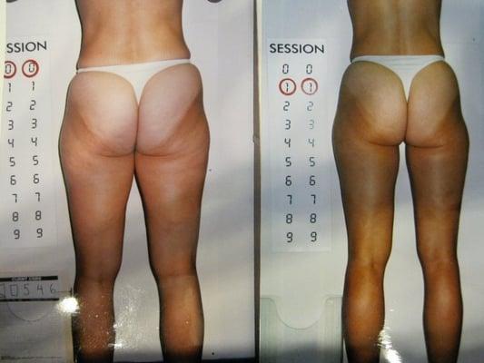 ENDERMOLOGIE:  Before & After