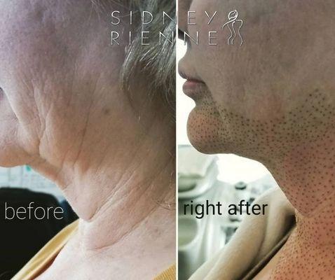 Fibroblast Plasma treatment on jowl and neck.