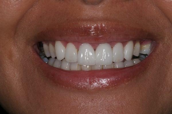 AFTER- Veneers