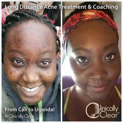 Long-distance acne client who uses our products in Uganda with coaching via email.