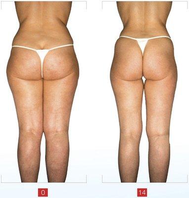 #endermologiebeforeandafter #endermologielosangeles #endermologiemanhattanbeach #bestcellulitetreatment #saygoodbyetocellulite #lpgsouthbay