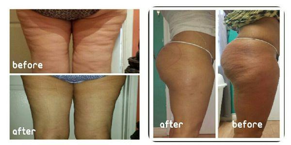 Cellulite Reduction Treatment