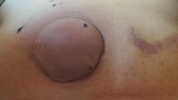 this picture was taken 9 days after the surgery. It sure looks like the hernia is still there