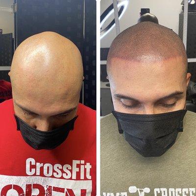 Scalp micro pigmentation 
Create your new bold hairline with universal scalps!