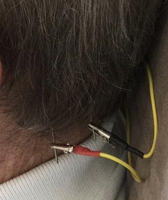 Neck acupuncture for hemiplegia from a stroke