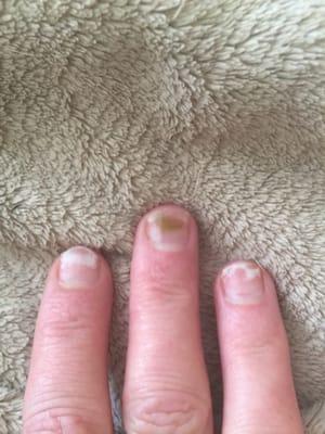 Nail fungus thanks to Hollywood Nails