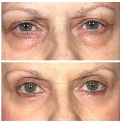 Bilateral blepharoplasty to correct upper eyelid hooding, removal of lower eyelid fat deposits, and Erbium laser resurfacing to lower eyelid