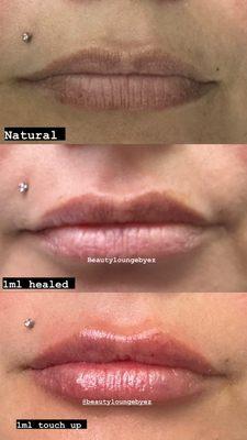 2 session needle-less filler results