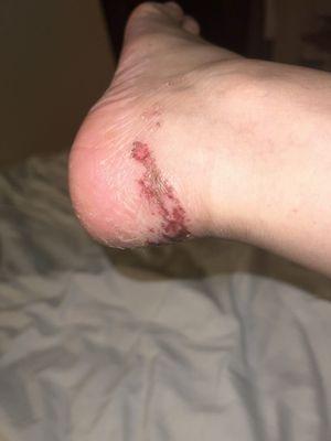 Infected ankle