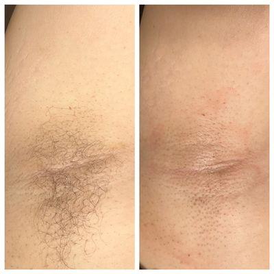 Underarm wax before & after