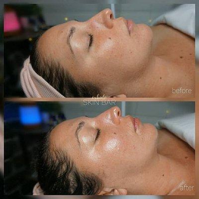 Sculptural Face Lifting w. Lymphatic Drainage & Gua Sha Results