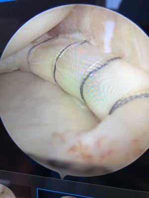 A large bucket handle meniscus tear was secured using a combination of advanced arthroscopic techniques.