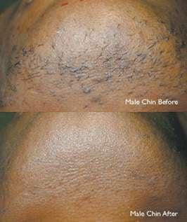 Laser Hair Removal for all skin type