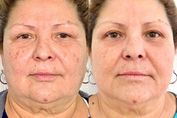 Amazing transformation using a combination of Fibroblast and Jet Plasma!