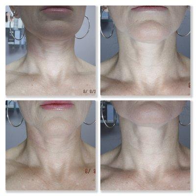 Pelleve skin tightening