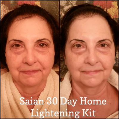 Before After 30 day home Hyperpigmentation treatment