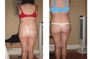 No Lipo Lipo before and after