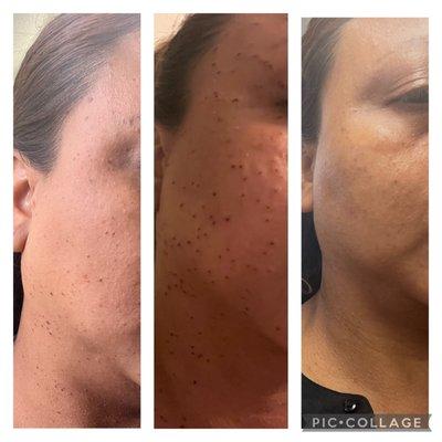 Face skin tag growth removal in Los Angeles Marina Del Rey Area. Quick and Pain free.