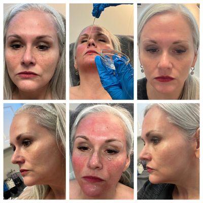 Microneedling results