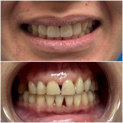 Before (bottom) after (top) pictures of individual crowns on her top front teeth.