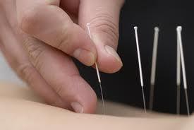 Needles simply placed to bring balance back to your body.